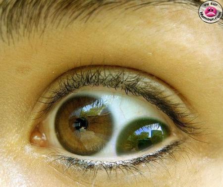 2 pupilles dans 1 oeil !!!!